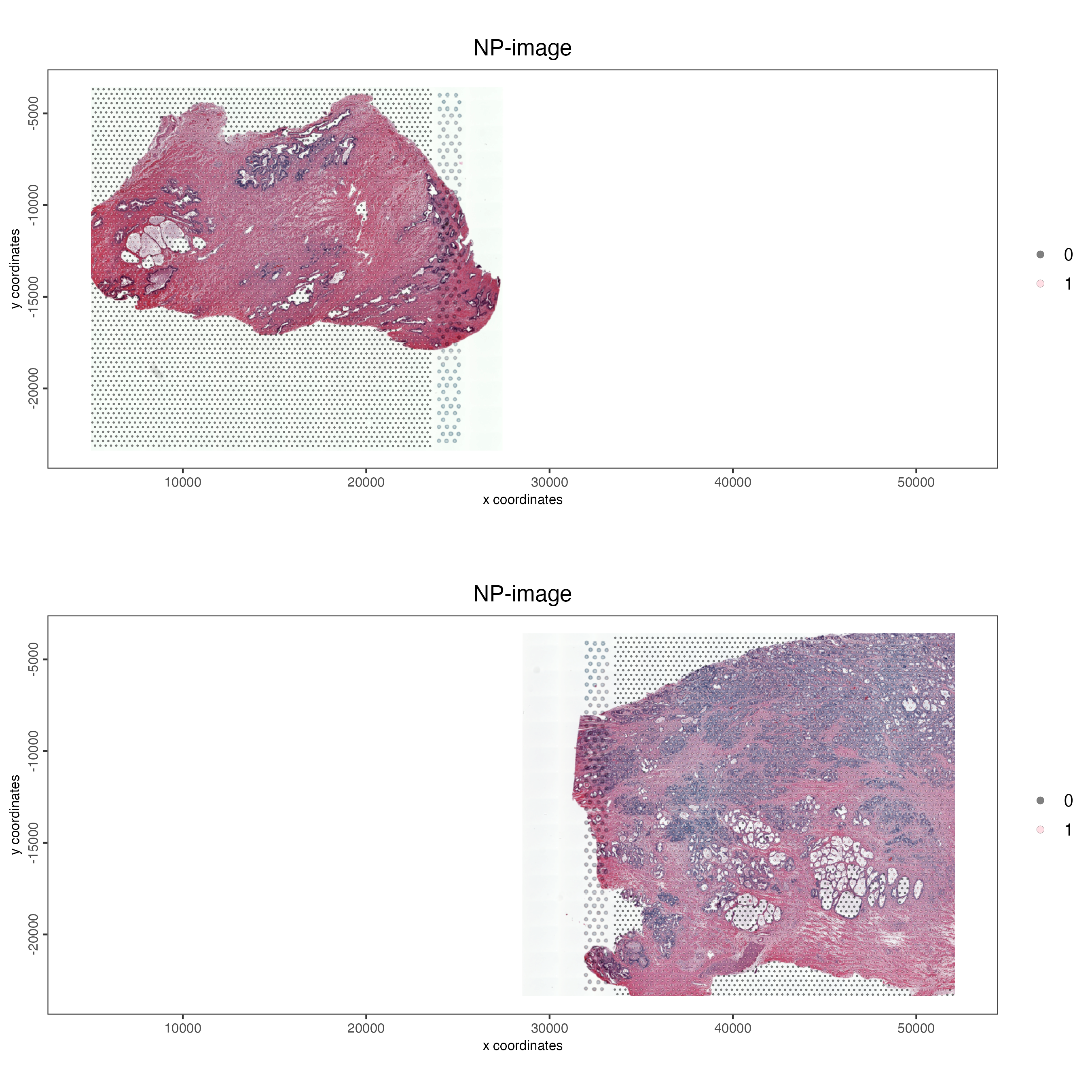 Vizualizing the visium spots that overlap tissue in normal prostate (left) and adenocarcinoma samples (right) in separate plots.