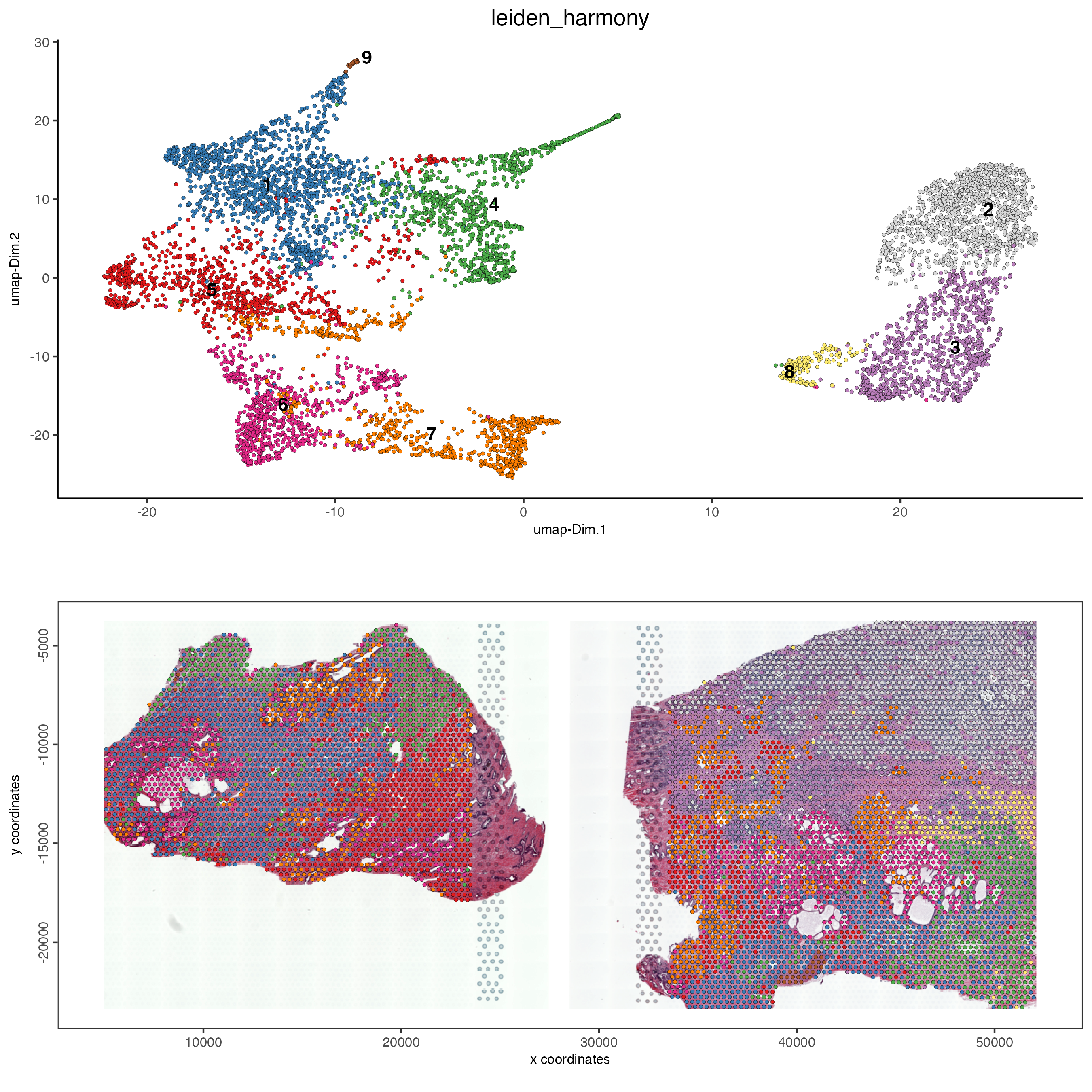 Leiden clustering after harmony was performed for the normal prostate (left) and the adenocarcinoma prostate sample (right).