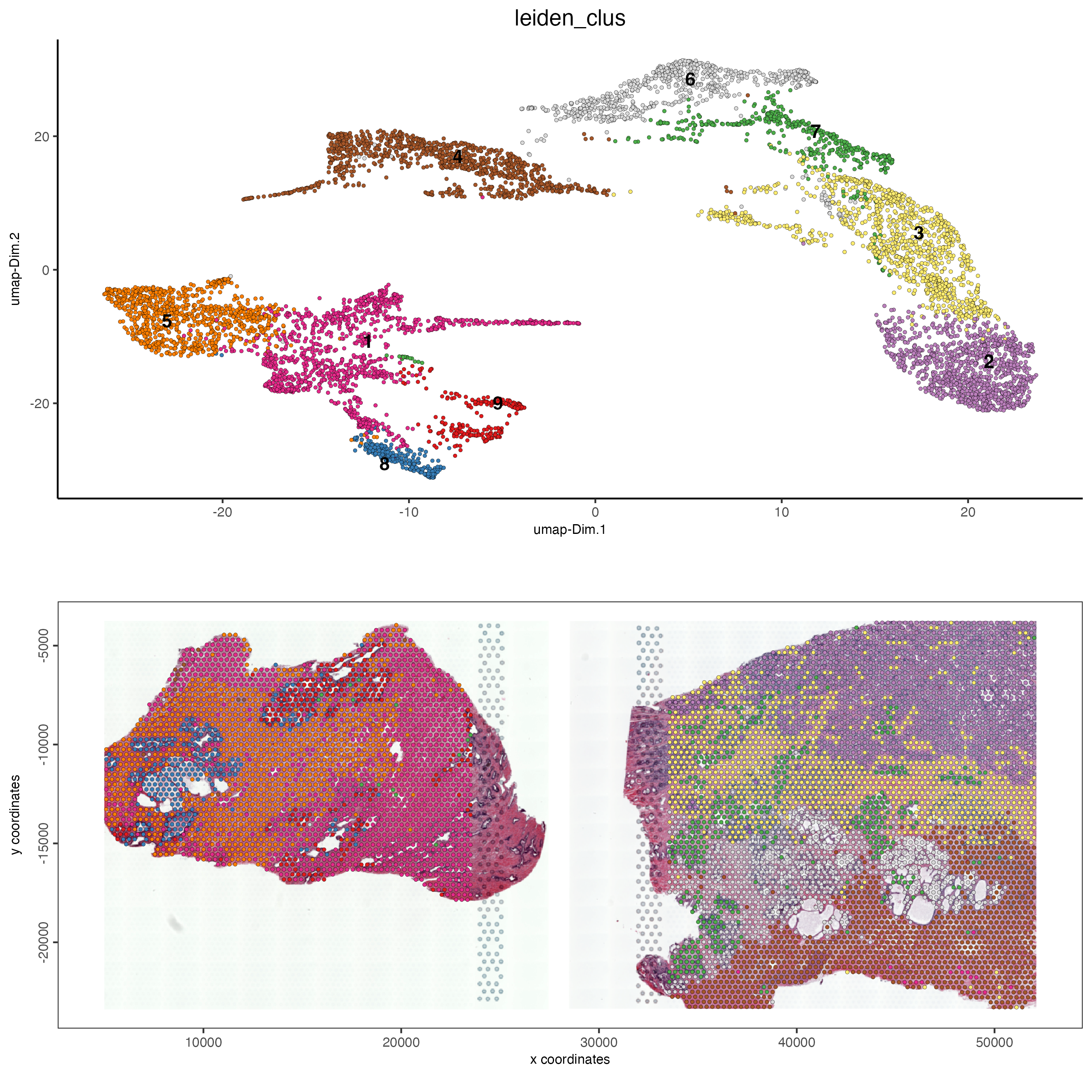 UMAP (top) for both samples colored by Leiden clusters visualized in a spatial plot (bottom) for the normal prostate (left) and the adenocarcinoma prostate sample (right).